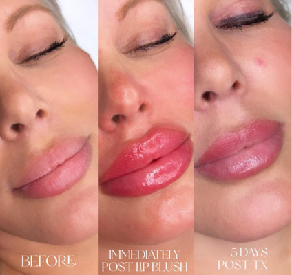Skinject Derin Hyaluronik Asit Dermal 2ml Dudak Dolguları Enjekte Edilebilir
