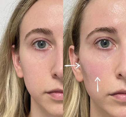 Skinject Derin Hyaluronik Asit Dermal 2ml Dudak Dolguları Enjekte Edilebilir