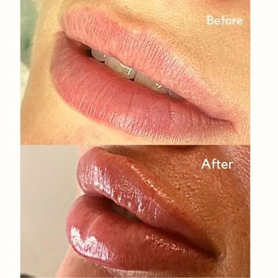 Dudak Hacmi İçin Enjekte Edilebilir Dolgu Enjeksiyonu Juvederms Ultra 3 HA Dermal Dolgu