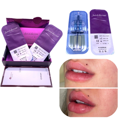 Enjeksiyon Ha Dolgu Juvederm 2x1ml Dudak Geliştirme Kırışıklıkları Giderir