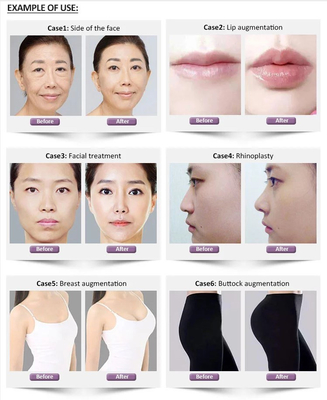 Revolax Fine Deep Sub-Q Hyaluronik Asit Çapraz Bağlantılı Dermal Dolgu 1.1ml