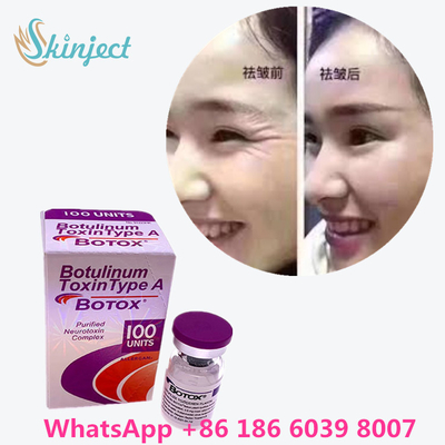 Botulinum Toxin  Kırışıklık Giderme 100u Allergan Yüz Germe Enjeksiyonu İçin 100 Adet