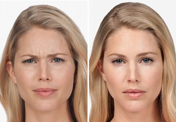 100 Iu Kırışıklık Karşıtı Ürünler Kore Botulinum Toksin Botoks Tip A