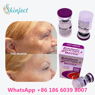 Cilt Yaşlanma Karşıtı Ürünler İçin Allergan Botoks Botulinum Toksin Tip A