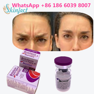 Cilt Yaşlanma Karşıtı Ürünler İçin Allergan Botoks Botulinum Toksin Tip A