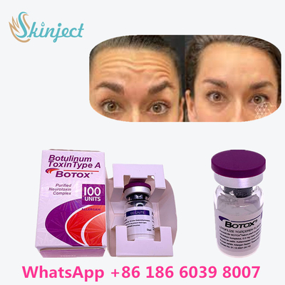 Kırışıklıkları Gidermek İçin %100 Orijinal Botulinum Toxin  100u