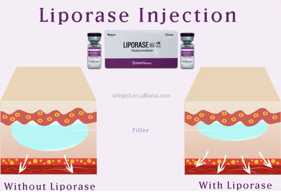 Dermal Dolgu Maddesinin Çözülmesi İçin 10 Vias Liporase Hyaluronidase