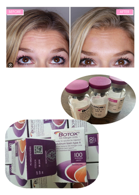 Anti kırışıklık botulinum toksin allergan 100IU 150iu  enjeksiyonları ' Na
