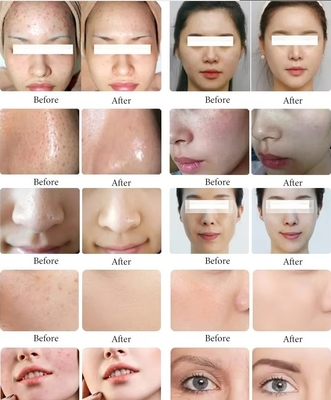 11 In 1 Çok Fonksiyonlu Hydra Dermabrasyon Yüz Makinesi Siyah İnci Yüz Temizleme Deri Bakım Cihazı
