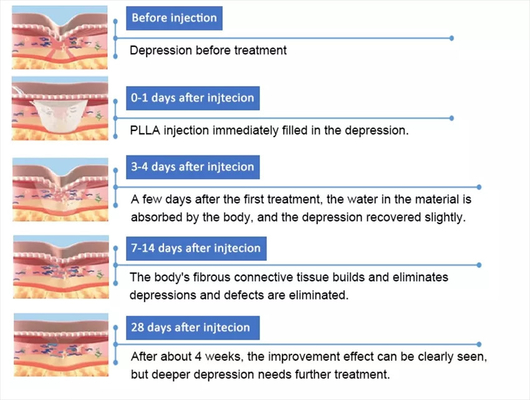 PLLA Poly- L- Laktik Asit Yüz Enjeksiyonu 10 Flakon 150mg