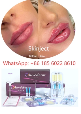 Juvederm Yüz Hyaluronik Asit Dermal Dolgu