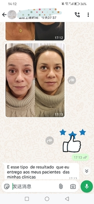1 şişe Dysport 500iu  Toxins Injection For Face satın alın.