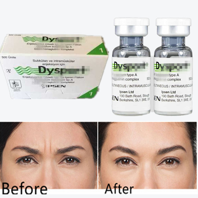 Botulinum Toxin Dysport Anti- kırışıklık tozu Glabellar çizgileri için dondurma kurutulmuş tozu