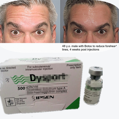 Botulinum Toxin Dysport Anti- kırışıklık tozu Glabellar çizgileri için dondurma kurutulmuş tozu