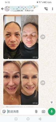 Kozmetik Dysport 500 Birim Botulinum Toksini Enjeksiyon için 500 IU Toz