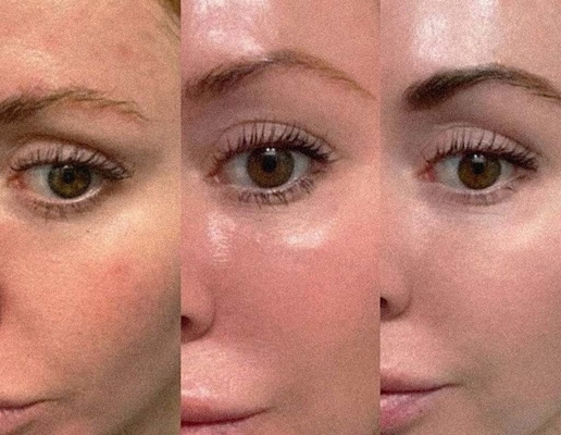Kolajen uyarımı Profhilo Enjekte edilebilir Dermal Filler Beş Noktalık kaldırma