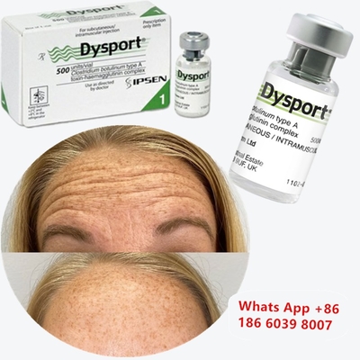 Botulinum Toksin Dysport Clostridium Botulinum Tip A Burun Düzeltme İçin