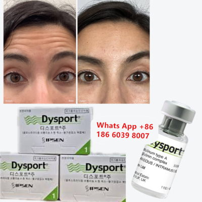 Dysport Botulinum Toksin Tipi A, Kaşları ve Glabellar çizgileri için