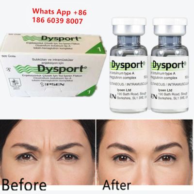 Dysport Botox Botulinum Toxin Type A Anti-Wrinkle Injection for Trapezius muscles