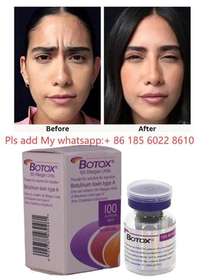 Botulinum Toksin Allergan Botox 100IU Enjeksiyon - Allergan ile Yaşlanma Belirtilerini Azaltın