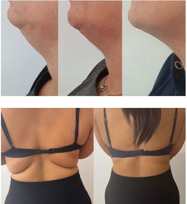 Limon Şişesi yağ çözücü enjeksiyonlar Lipolitik Çözelti