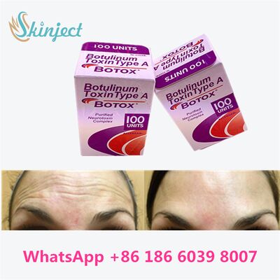Allergan Botox Botulinum Toxin Tip A kırışıklığı kaldırmak için 100 birim 4 ~ 6 ay süren