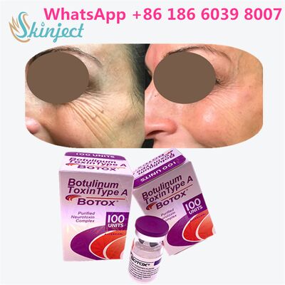 Allergan Botox Botulinum Toxin Tip A kırışıklığı kaldırmak için 100 birim 4 ~ 6 ay süren