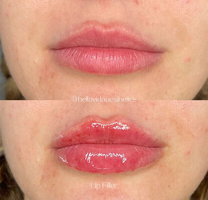 2 yıl raf ömrü, kırışıklık azaltma, yüz şekillendirme ve cilt canlandırma için tasarlanmış dermal dolgu enjekte edilebilir jel