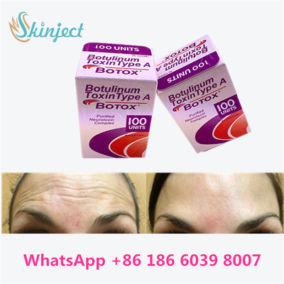 Glabellar çizgiler için Botulinum Toksin Allergan BOTOX Kozmetik Enjeksiyonu 100 Ünite