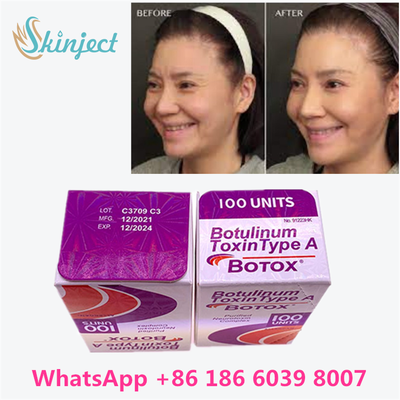 Glabellar çizgiler için Botulinum Toksin Allergan BOTOX Kozmetik Enjeksiyonu 100 Ünite