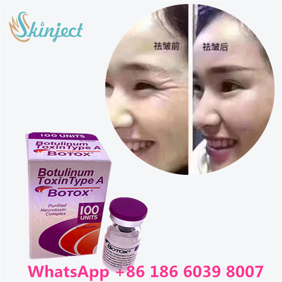 Botulinum Toksin Allergan Botox Beyaz Toz, Yüz Çizgileri ve Kas Gevşetme İçin Etkili Tedavi