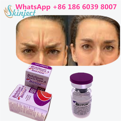 Botulinum Toksin BOTOX Kozmetik 100 Birim Alerjan Onabotulinum ToksinA Yüz kırışıklıkları için