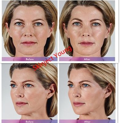 Juvederm Voluma 2x1ml Hyaluronik Asit Enjekte Edilebilir Jel Dolgu Maddeleri