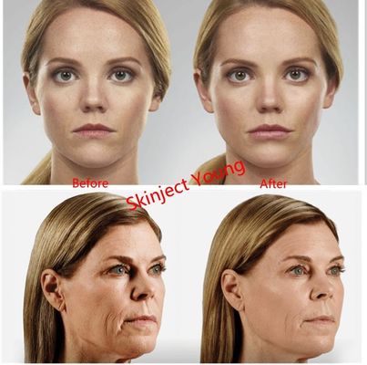 Juvederm Voluma 2x1ml Hyaluronik Asit Enjekte Edilebilir Jel Dolgu Maddeleri