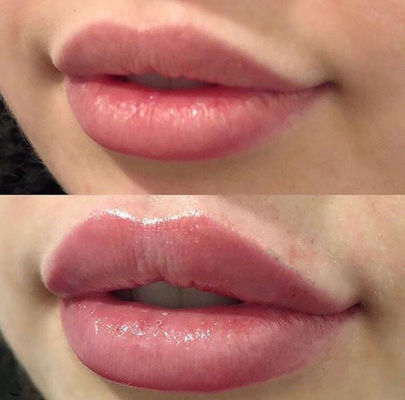 Lidokain Çapraz Bağlı Dermal Dolgu ile Rus Dudakları Juvederm Ultra 3