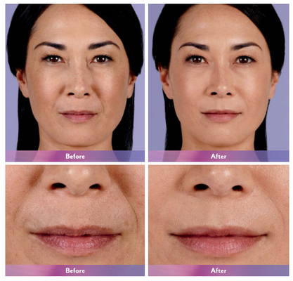 Dudak Büyütme İçin Juvederm Dermal Dolgu Dudak Enjeksiyonu Ultra 4