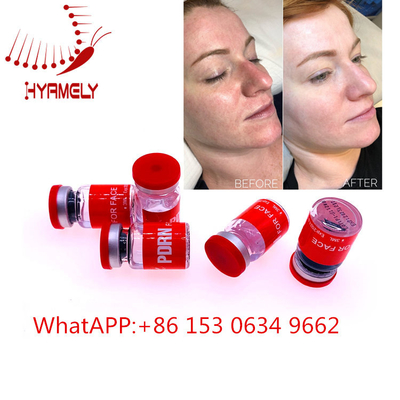 Hyaluron Kalem Dermal Dolgu ile Yaşlanma Karşıtı Meso Serum Enjeksiyonu