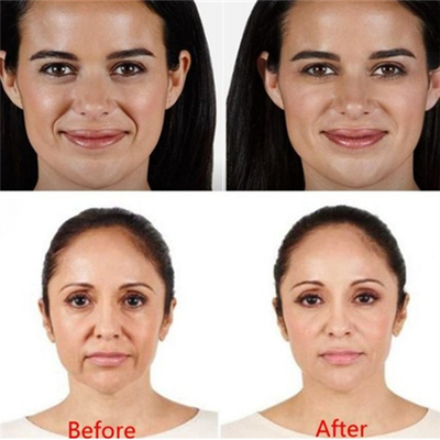 Çapraz Bağlantılı Dermal Dolgu Juvederm Hyaluronik Asit Kırışıklık Giderme