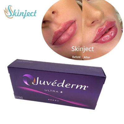 Juvederm 2 * 1ml Dudak Dolgusu Hyaluronik Asit Lido Ultra4 ile Dermal Dolgu
