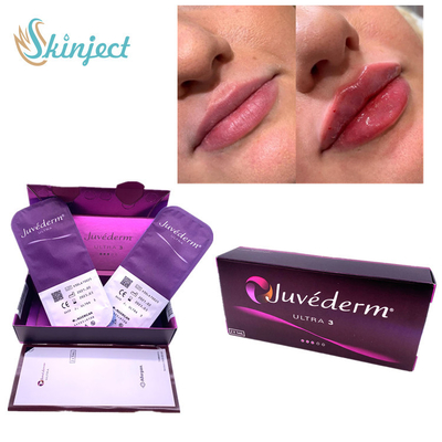 Nazolabial Kıvrımlar Dudaklar 2x1ml Dermal Dolgu Hyaluronik Asit Juvederm Ultra3