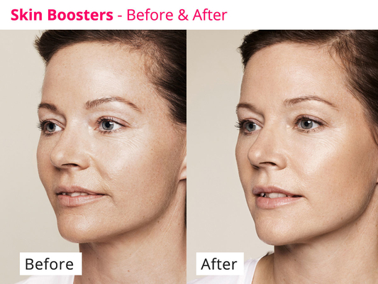 Kollajen Yenilenmesi İçin Cilt Gençleştirici PDRN Skinbooster Meso Serum