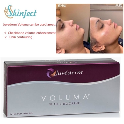 Elmacık kemiği için Juvederm Voluma 2x1ml Hyaluronik Asit Dermal Dolgu Maddeleri