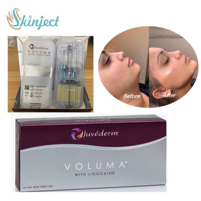 Yüz Yanak Çene Çevresi için Juvederm Voluma Dermal Dolgu Hyaluronik Asit