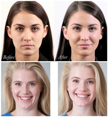 Çene ve Yanak Büyütme İçin Juvederms Voluma Hyaluronik Asit Yüz Dolgusu