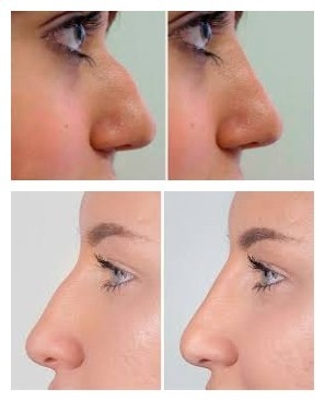 Çene ve Yanak Büyütme İçin Juvederms Voluma Hyaluronik Asit Yüz Dolgusu
