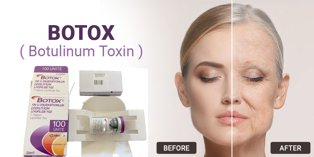 Yüz Kırışıklıklarının Giderilmesi İçin 100 Adet Allergan Botulinum Toksin A Tipi Enjeksiyon