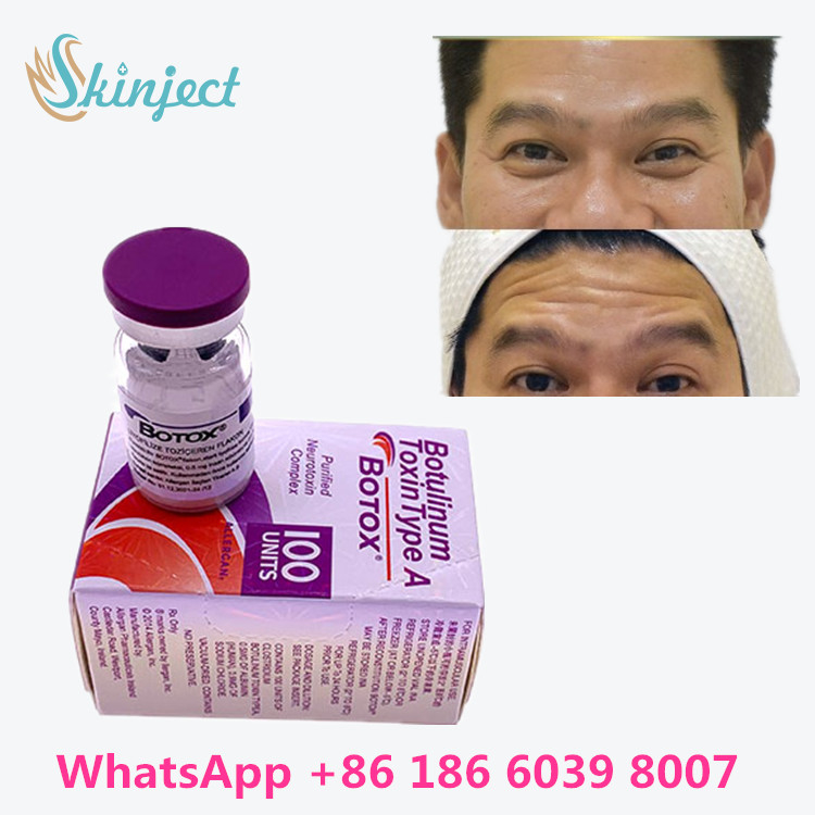 100 Ünite Tip A Botulinum Toksini 2 - 8°C Saklama Sıcaklığı