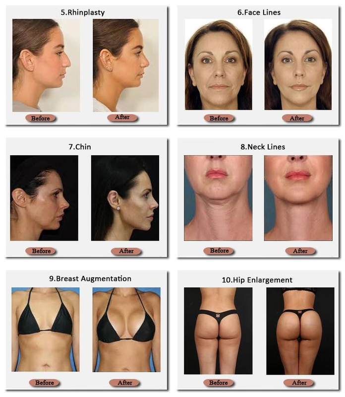 Skinjection 10 Ml Ve 20 Ml Hyaluronik Göğüs Dolgusu Kore Teknolojisi 24 Mg/Ml