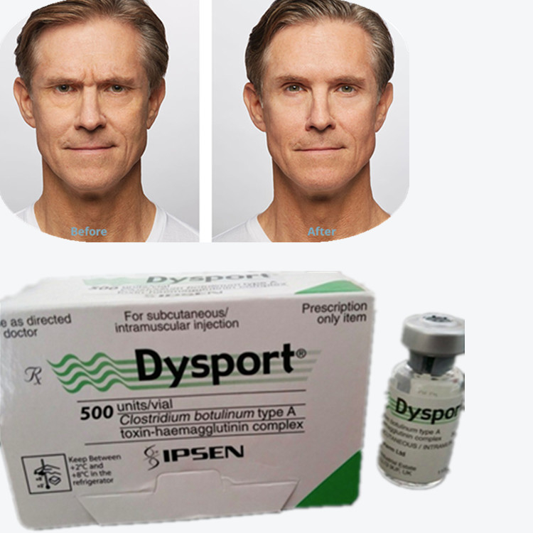 Botulinum Toxin Dysport 100IU, kırışıklık kaldırma için A tipi botulinum toksin