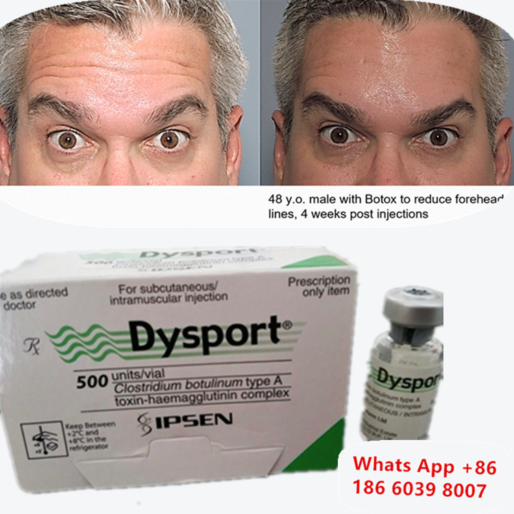 Botulinum Toksin Dysport Botox Clostridium Botulinum Tip A Kaş Kaldırma İçin